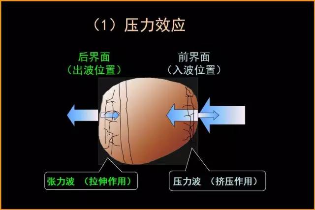 打冲击波后注意事项_打完冲击波要休息几天_冲击波后疼痛多久消除